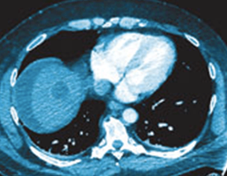 xray of a tumor